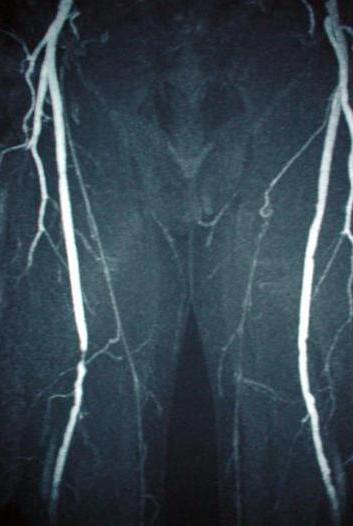 la angiografía de los vasos de las extremidades inferiores