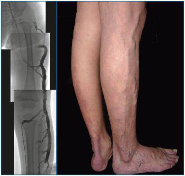 angiography of vessels of lower extremities reviews