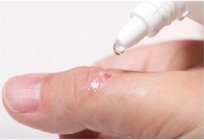 What is a scab? The surface of the wound. Wound infection