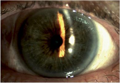 artificial eye lens