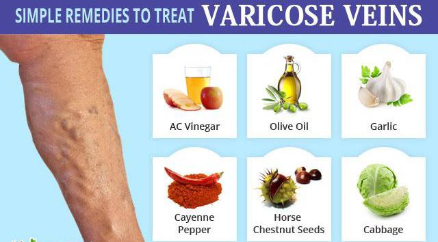 remédios populares da варикоза de veias nas pernas