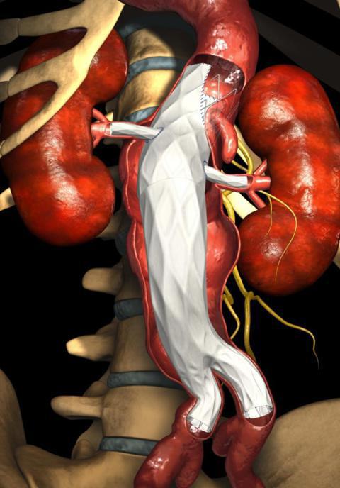 ущільнення аорти серця