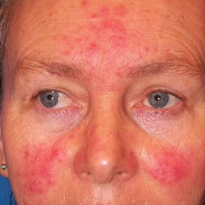 treatment of demodicosis on the face