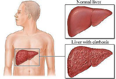 how to cure liver folk remedies