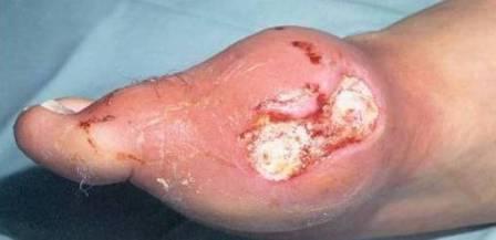 treatment of purulent wounds