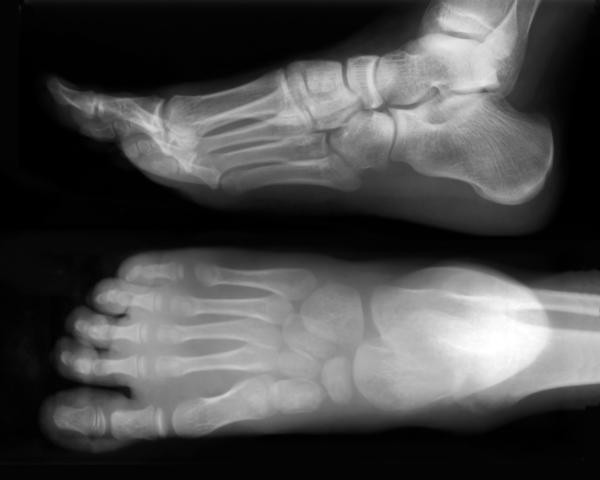 Navicular of foot