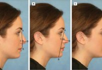 Correction of the nasal tip: reviews. Rhinoplasty in Moscow