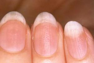leczenie ониходистрофии paznokci na rękach