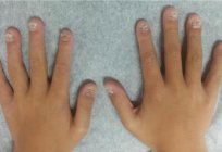 Onihodistrofiya爪の治療や薬の民間療法