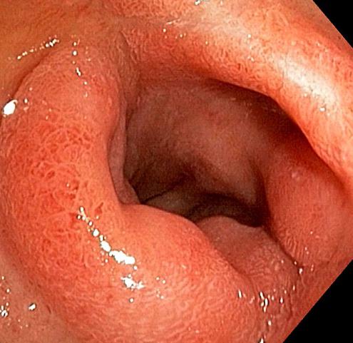un síntoma de la úlcera duodenal