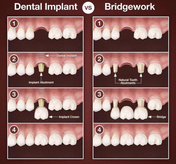 un puente o un implante en la masticación diente de los clientes