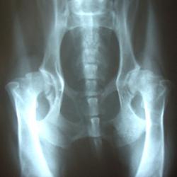 la artritis de rodilla