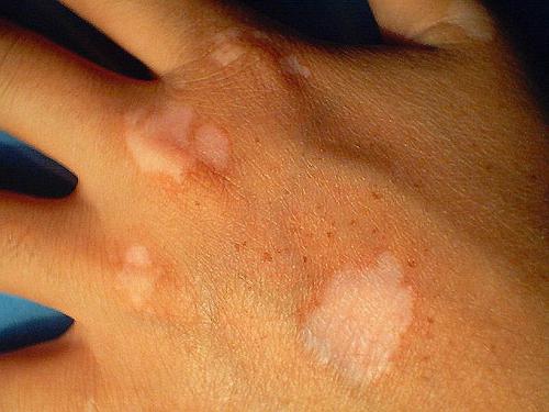 white spots on the hands and feet