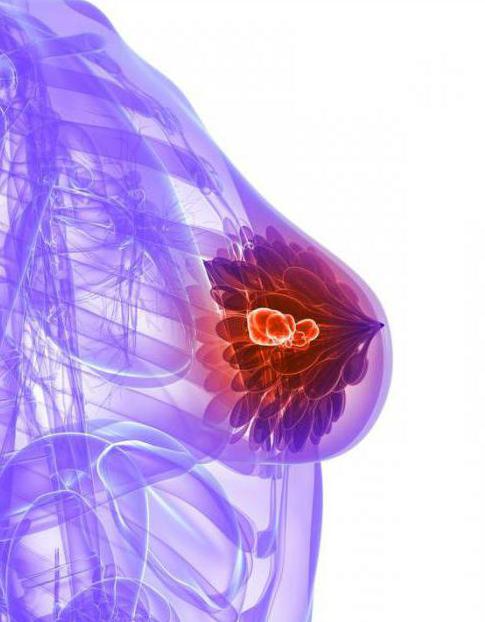 Микрокальцинаты na glândula mamária - o que é