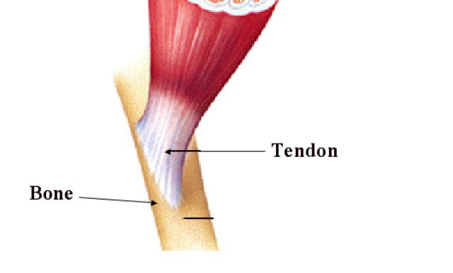 tendon rupture