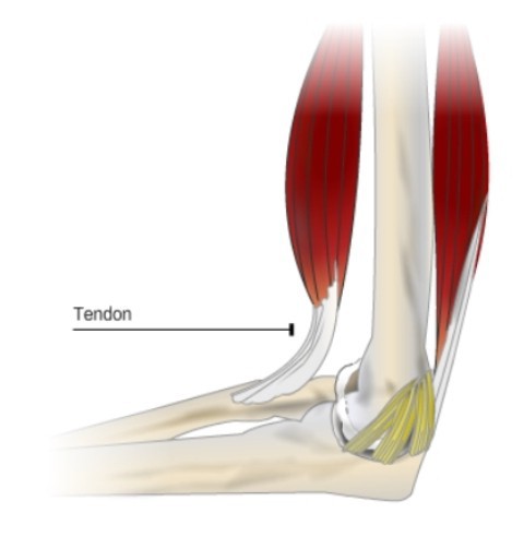 lesiones de los tendones