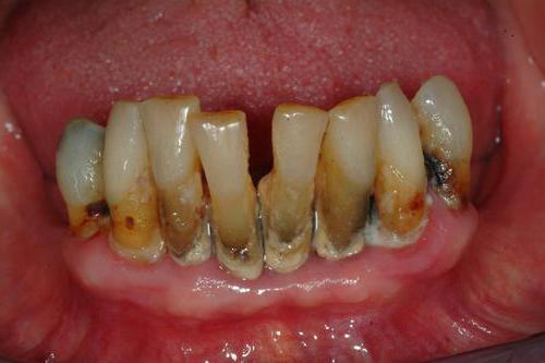 die schlimmsten Zähne der Welt