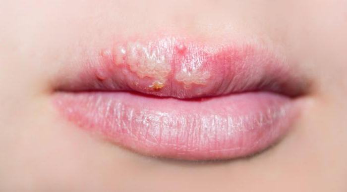 small blisters on the lips
