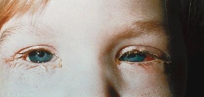 conjunctivitis in a child than to treat