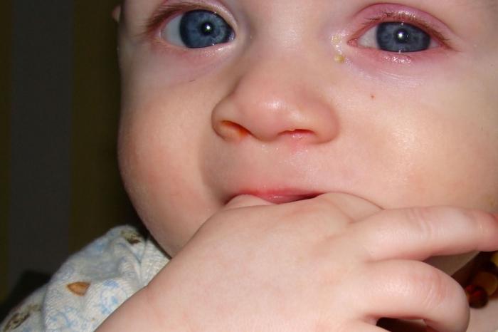 迹象的结膜炎在儿童
