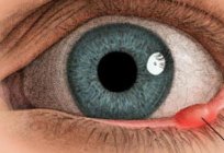 内部styeに下眼瞼:処理、その原因と影響