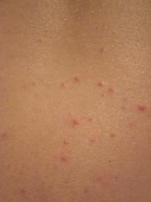 ¿por qué muchas personas tienen acné en la espalda