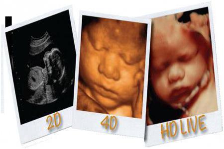 4D ultrasound 20 weeks