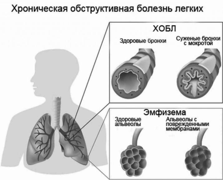 Обструктивна хвороба легень