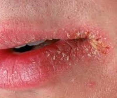 die Risse in den Ecken der Lippen Behandlung