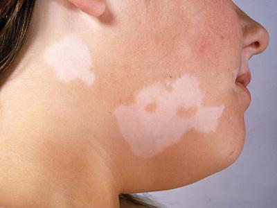 las Causas del vitiligo