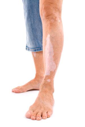 a Doença vitiligo: causas