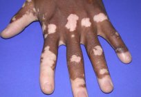 Was sind die Symptome und Ursachen der Vitiligo?