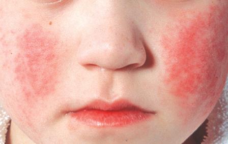 parvovirus infection in children rash