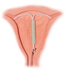 what is an intrauterine device better reviews