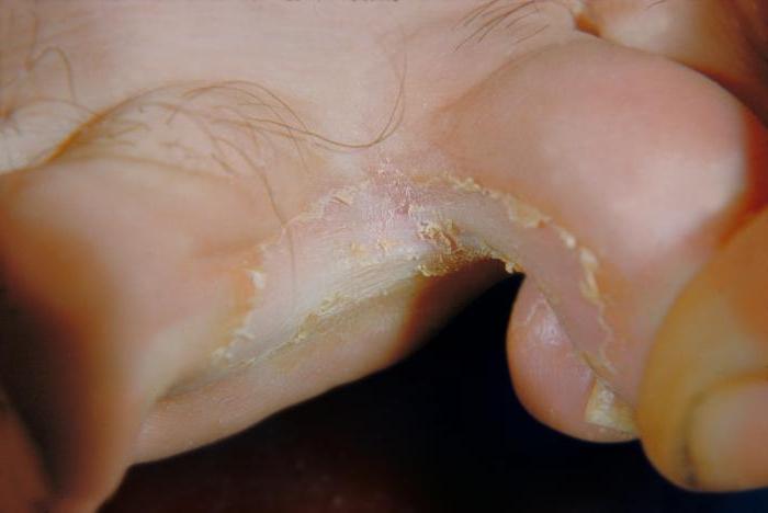 foot fungus symptoms photos