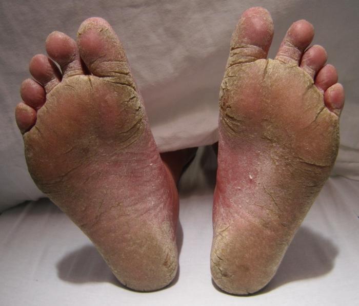 o fungo do pé sintomas tratamento