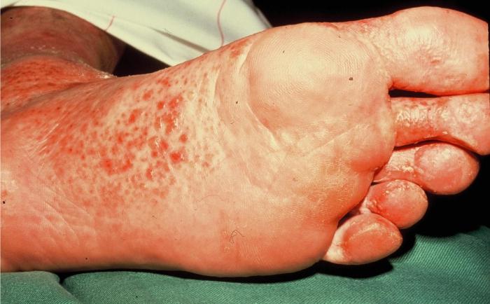脚真菌症状