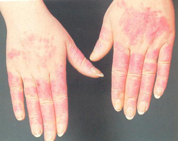 алергія на холад на руках сімптомы і лячэнне