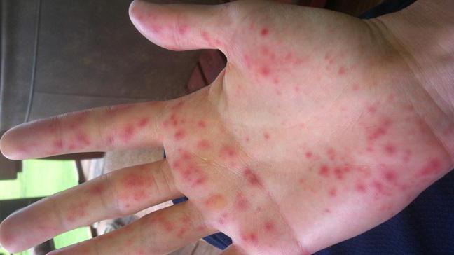 the ointment from an Allergy to cold on the hands