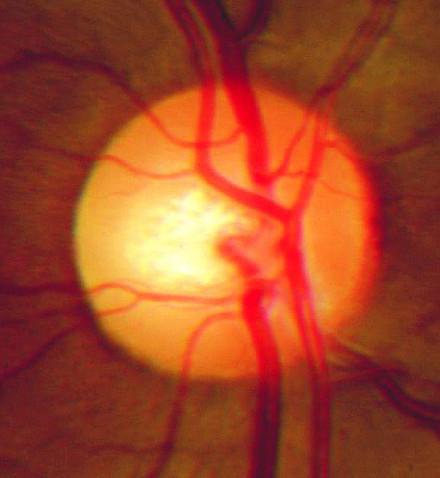 przyczyną rozwoju stagnacji tarczy nerwu wzrokowego są