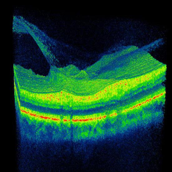 estagnada disco do nervo óptico tratamento