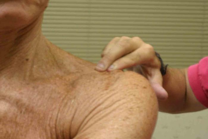 деформуючий артроз плечового суглоба