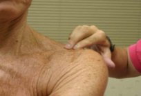 Shoulder joint arthrosis: treatment, symptoms and causes of