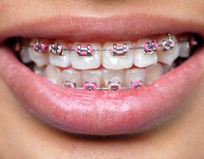 o valor ortodôntica em dentes