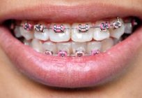 The advantages of braces: types and cost of braces