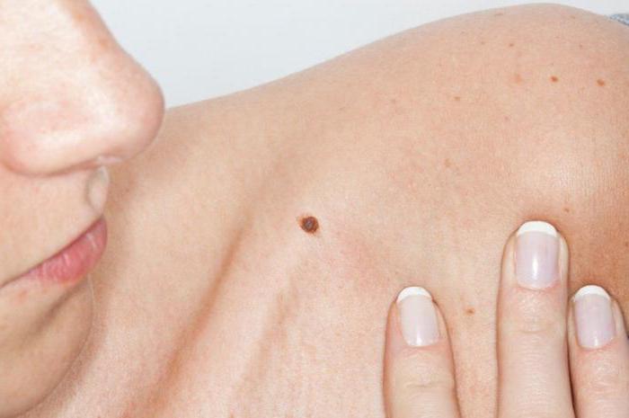 can I remove moles on the body