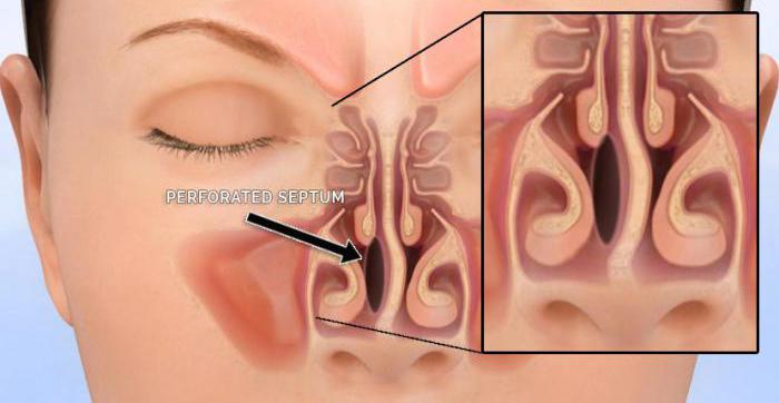 la perforación del tabique nasal