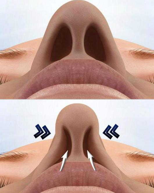 перфорація носової перегородки лікування