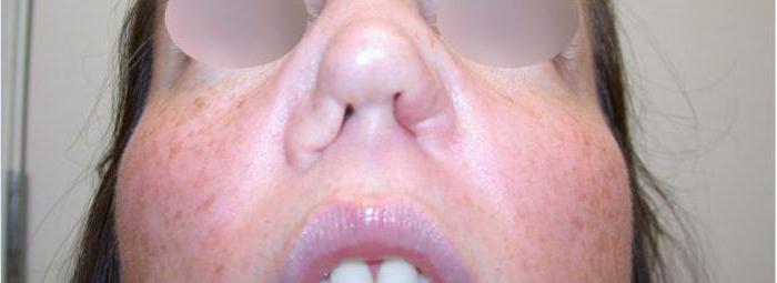 perfuração nasal divisória consequências