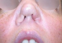 Perforation of the nasal septum: causes, symptoms, treatment and consequences